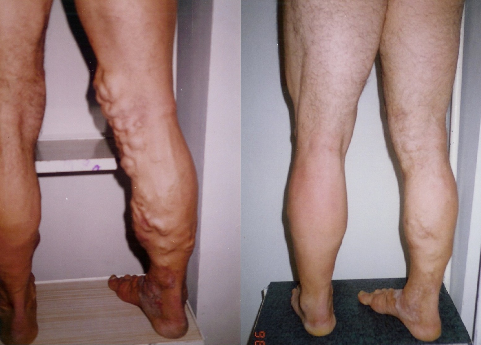 tratamentul dupa operaie varicoza picior